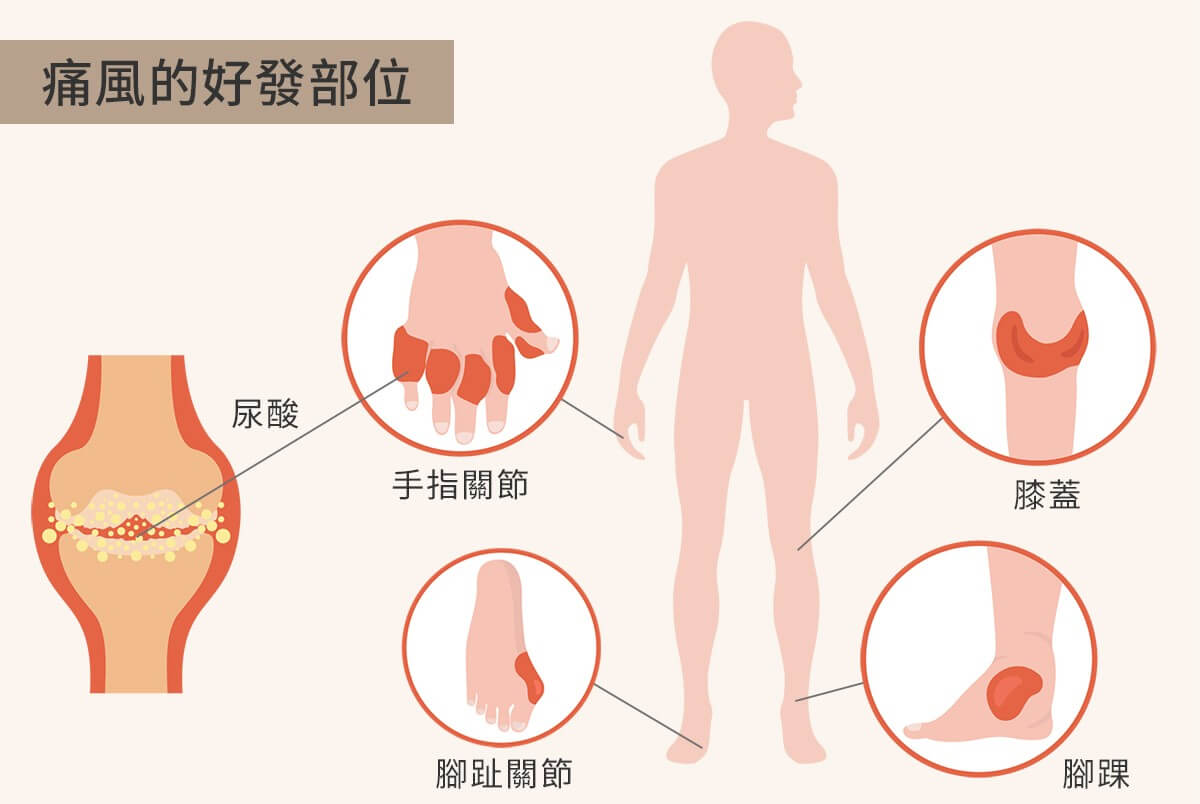 痛风陷阱 长痛风石十多年肿如鸡蛋 18岁少年惨患痛风坐 轮椅 医疗 癌症 红蓝卡保险 安心医保